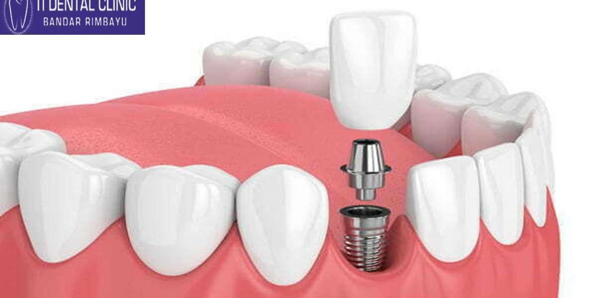The Ultimate Guide to Dental Implants and Invisible Braces (Tidental)