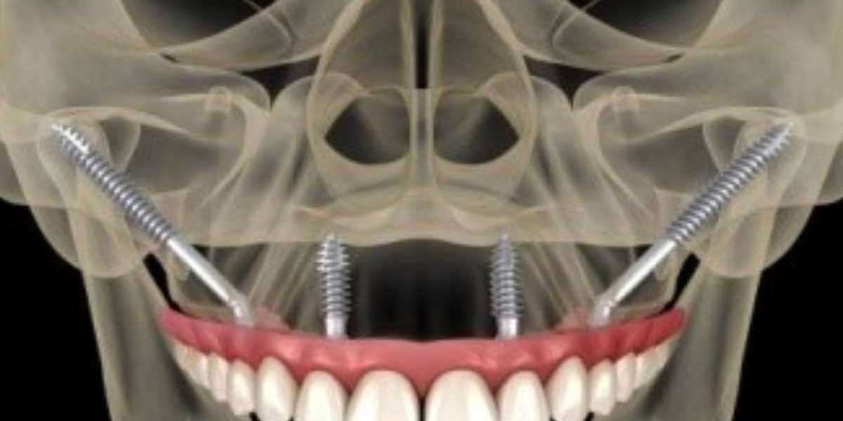 5 Benefits of Zygomatic Implants for Patients with Severe Bone Loss